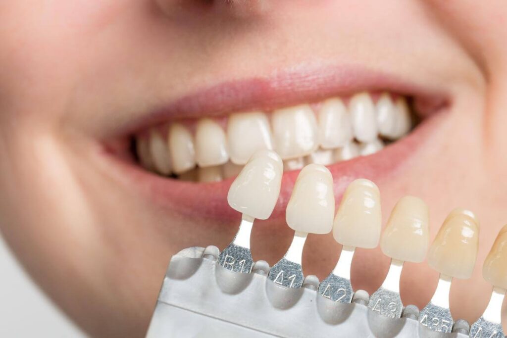 Bringing Out The Best Smile: The Magic Of Dental Veneers