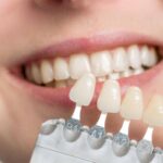 Dental Veneers