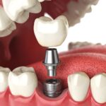 dental implants Texas