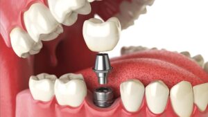 dental implants Texas