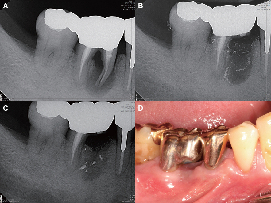 Vital Root Amputation: A Conservative Approach to Saving Teeth