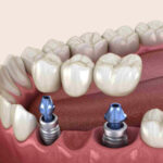 Dental Implant Surgery