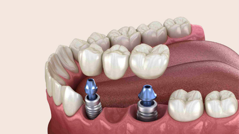 Dental Implant Surgery