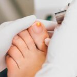 Expert fungal nail treatment Sydney