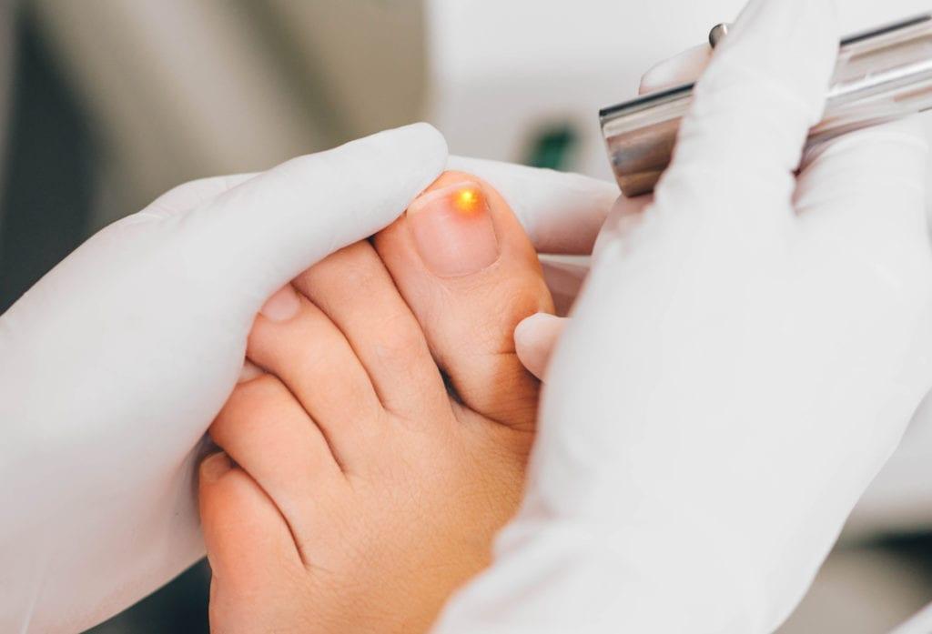 Expert fungal nail treatment Sydney